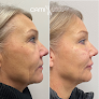 Your hair transplant and cost Carolina Age Management Institute Huntersville in Huntersville in North Carolina