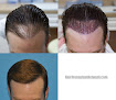 Your hair transplant and cost Carolina Hair Surgery: Fue Hair Transplant in Mount Pleasant in South Carolina