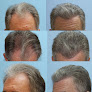 Your hair transplant and cost Carolina Hair Surgery in Fort Mill in South Carolina