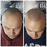 Your hair transplant and cost Carolina Scalp Center in Raleigh in North Carolina