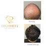 Your hair transplant and cost Celebrity Hair Restoration in McLean in Virginia