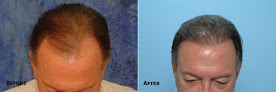 Your hair transplant and cost Central Florida Hair Restoration in Altamonte Springs in Florida