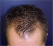 Your hair transplant and cost Chesapeake Hair Restoration - Hair Transplants In Baltimore, Maryland in Timonium in Maryland