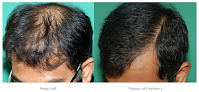 Your hair transplant and cost Chicago Hair Institute in Oakbrook Terrace in Illinois