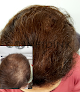 Your hair transplant and cost Confidink, Hair Loss Services in Riverton in Utah