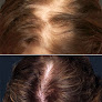 Your hair transplant and cost Corridor Hair Restoration in Coralville in IA