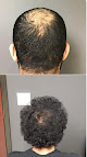 Your hair transplant and cost Dallas Hair Md in Grapevine in Texas