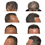Your hair transplant and cost Dallas Hair Transplant Center - Dr. Stefan P. Thiele in Dallas in Texas