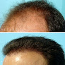 Your hair transplant and cost Darling Hair Restoration in Kansas City in MO