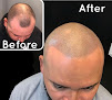 Your hair transplant and cost Deja Vu Hair Design in Woodland Hills in California