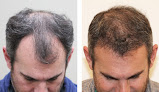 Your hair transplant and cost Denver Hair Surgery in Lone Tree in Colorado
