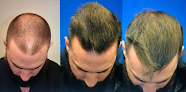 Your hair transplant and cost Dgmd Medical in Omaha in Nebraska