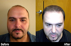Your hair transplant and cost Distefano Hair Restoration Center in Lexington in Massachusetts