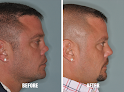 Your hair transplant and cost Dr. Anthony Bared, Md, Facs - Hair Restoration & Rhinoplasty in Miami in Florida