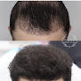 Your hair transplant and cost Dr. Hair Of Chicago in Chicago in Illinois