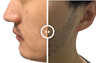 Your hair transplant and cost Dr. Kourosh Kojouri | Artas Hair Restoration & Transplant in Los Altos in California