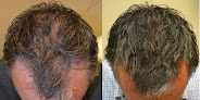Your hair transplant and cost Dr. Nicole Rogers in Metairie in Louisiana