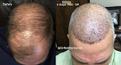 Your hair transplant and cost Dr. Rob Berberian in Newport Beach in California