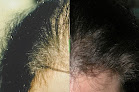 Your hair transplant and cost Dr. Robin Unger in New York in New York
