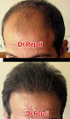 Your hair transplant and cost Dr.rejali Hair&Skin Restoration in Scottsdale in AZ