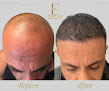 Your hair transplant and cost Eternal Hair & Esthetics in Totowa in New Jersey