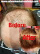 Your hair transplant and cost Extensions Hair And Wig Salon in Minneapolis in Minnesota