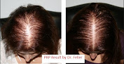 Your hair transplant and cost Feller & Bloxham Medical in Great Neck in New York