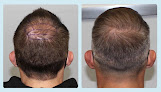 Your hair transplant and cost Feller & Bloxham Medical in St. Louis in Missouri