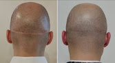 Your hair transplant and cost Finishing Touch Smp Scalp Micropigmentation in Las Vegas in Nevada