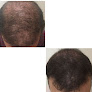 Your hair transplant and cost Follicles Smp in Atlanta in Georgia