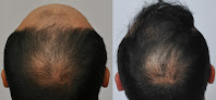 Your hair transplant and cost Forhair Hair Transplant Clinic in Alpharetta in Georgia