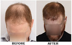 Your hair transplant and cost Forhair Nyc Restoration Clinic - Dr. John Cole in New York in New York