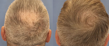 Your hair transplant and cost Fue Hair Transplant Solution New Jersey in Tinton Falls in New Jersey