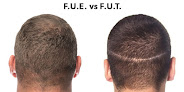 Your hair transplant and cost Fue Paradise in Green Valley in Santa Cruz