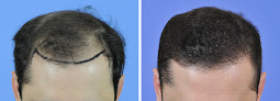 Your hair transplant and cost Gabel Hair Restoration Center in Portland in Oregon