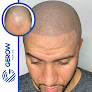 Your hair transplant and cost Gerow Hair Ink in New York in New York
