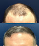 Your hair transplant and cost Glat Hair By Morgenstern Medical in Bala Cynwyd in Pennsylvania
