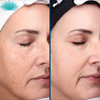 Your hair transplant and cost Glow Aesthetics Medical Spa in South Burlington in Vermont