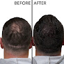 Your hair transplant and cost Good Look Ink in Bloomington in Minnesota
