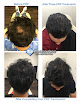 Your hair transplant and cost Grow Your Hair Back Hair Transplant Clinic in McLean in Virginia