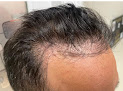 Your hair transplant and cost Hair 4 Life Medical in Scottsdale in AZ