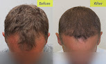 Your hair transplant and cost Hair By Dr. Max, Restoration Center in Fort Lauderdale in Florida