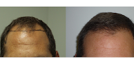 Your hair transplant and cost Hair & Facial Plastics Institute-Dr. James Aronovitz in Warren in Michigan