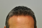 Your hair transplant and cost Hair Forever, Llc in North Little Rock in Pulaski