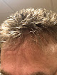 Your hair transplant and cost Hair Replacment Associates in Stoughton in Massachusetts