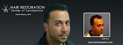 Your hair transplant and cost Hair Restoration Center Of Connecticut in Wethersfield in CT