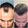 Your hair transplant and cost Hair Restoration Detroit in Dearborn in Michigan