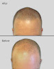 Your hair transplant and cost Hair Restoration Institute Of Dfw in Fort Worth in Texas