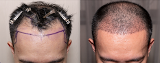 Your hair transplant and cost Hair Restoration Institute Of Georgia in Peachtree City in Georgia
