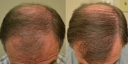 Your hair transplant and cost Hair Restoration Of The South in Metairie in Louisiana